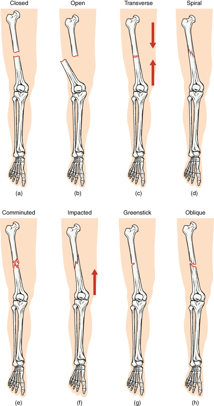 fracture of a bone