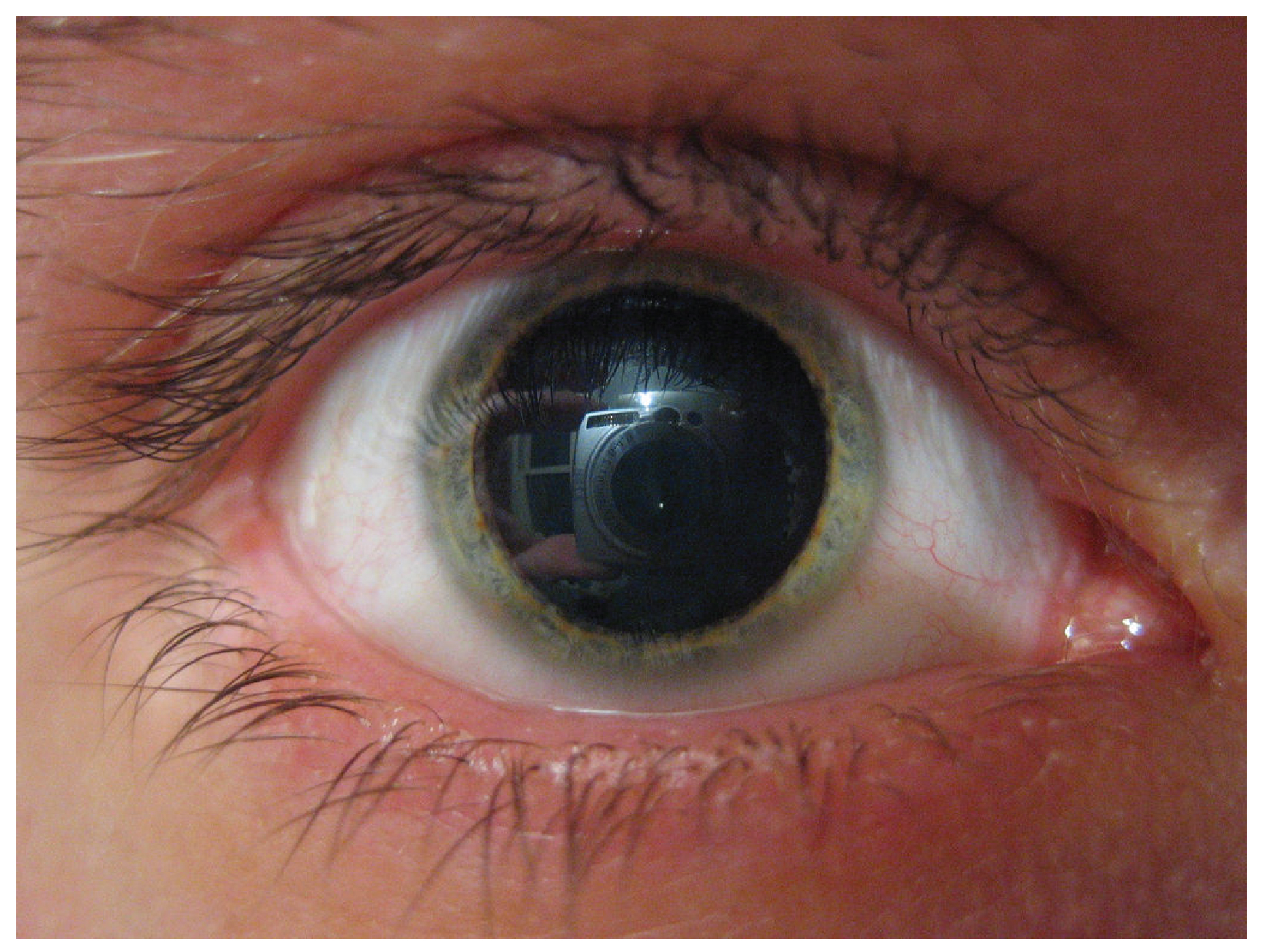 eye pupil dialation