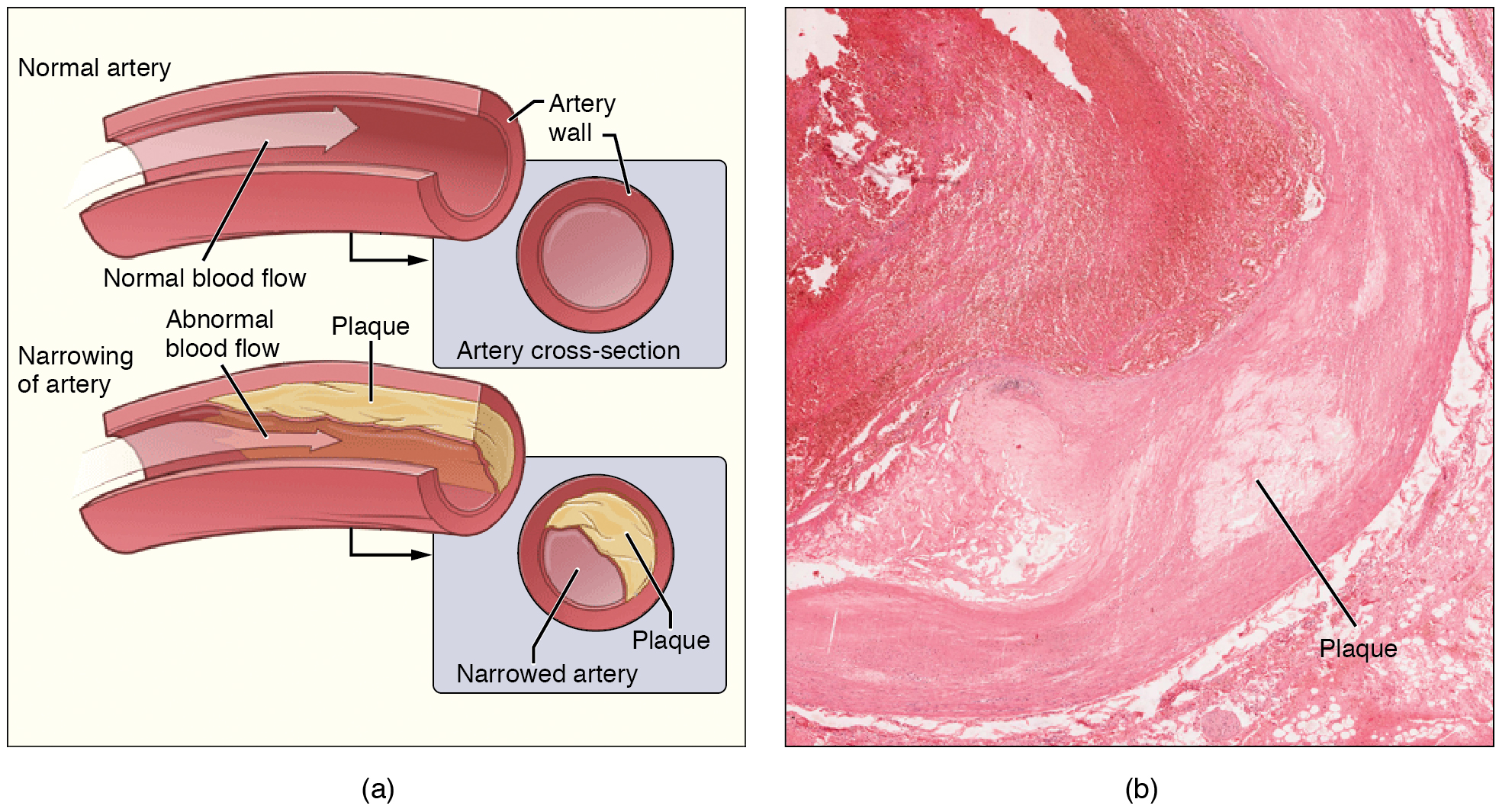The left panel shows the cross-section of a normal and a narrowed artery. The right panel shows a micrograph of an artery with plaque in it.
