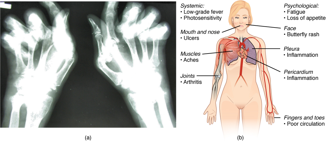 The left panel of this figure shows an x-ray image of a person’s hand with rheumatoid arthritis, and the right panel of this figure shows a woman’s body with labels showing the different responses in the body when the patient suffers from lupus.