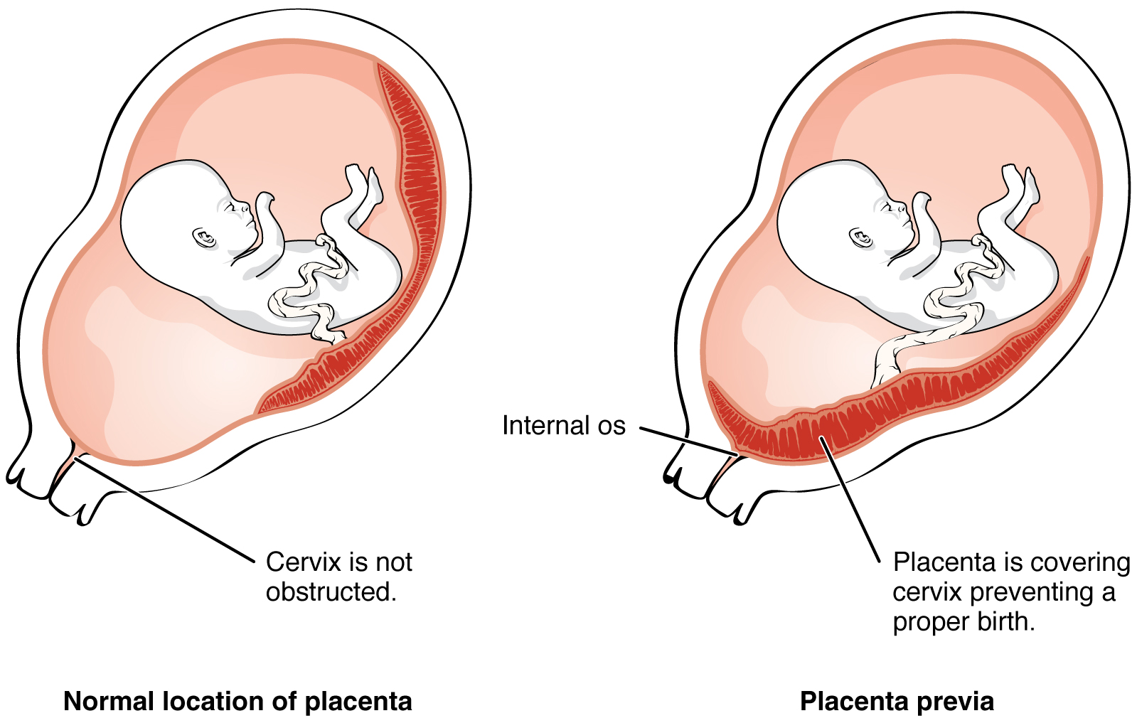 The left panel of this image shows the normal location of the placenta and the right panel shows the location of the placenta in placenta previa.