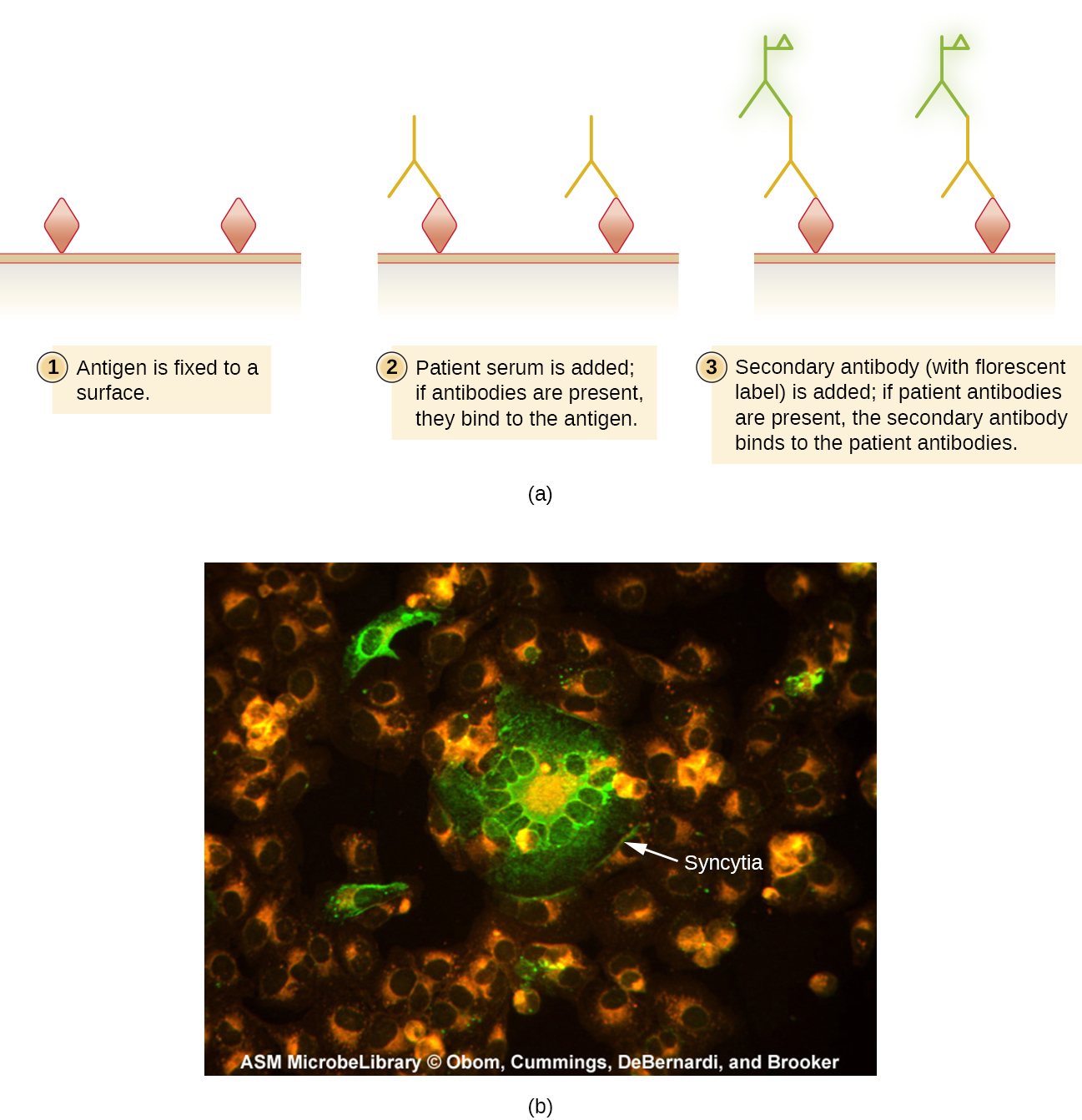 Diagram of an IFA test. Antigens are bound to a surface. The patient serum is added. If the matching antibodies are present they bind to the antigen. A secondary antibody (with a fluorescent label) is added. If the patient antibodies are present the secondary antibody binds to the patient antibodies.