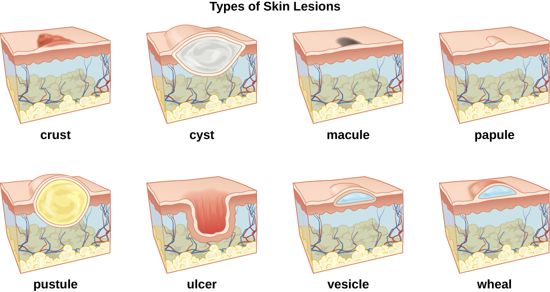 primary-skin-lesions-rheumatic-diseases-skin-wound-care-nursing