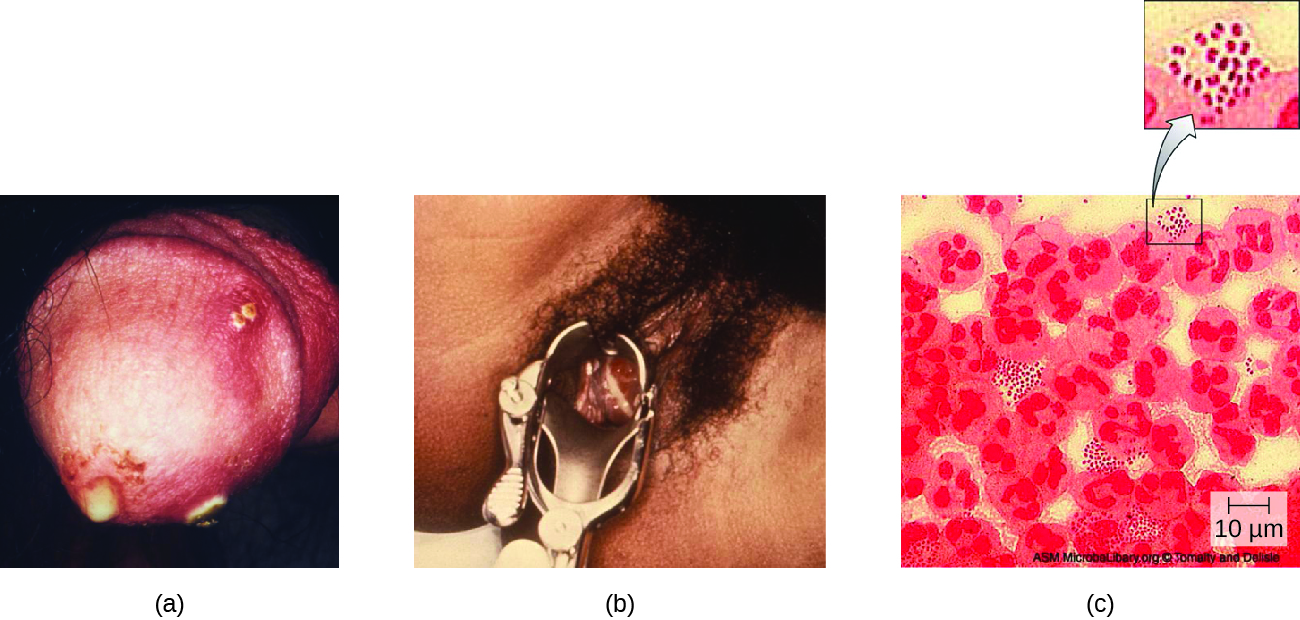 part a shows a penis with white discharge. Part b shows a vagina with a metal tool. Part c is a micrograph of urethral discharge showing red spots on a yellow background.