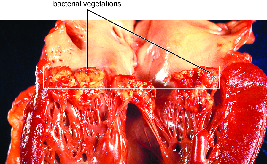 Bacterial Infections of the Circulatory and Lymphatic Systems