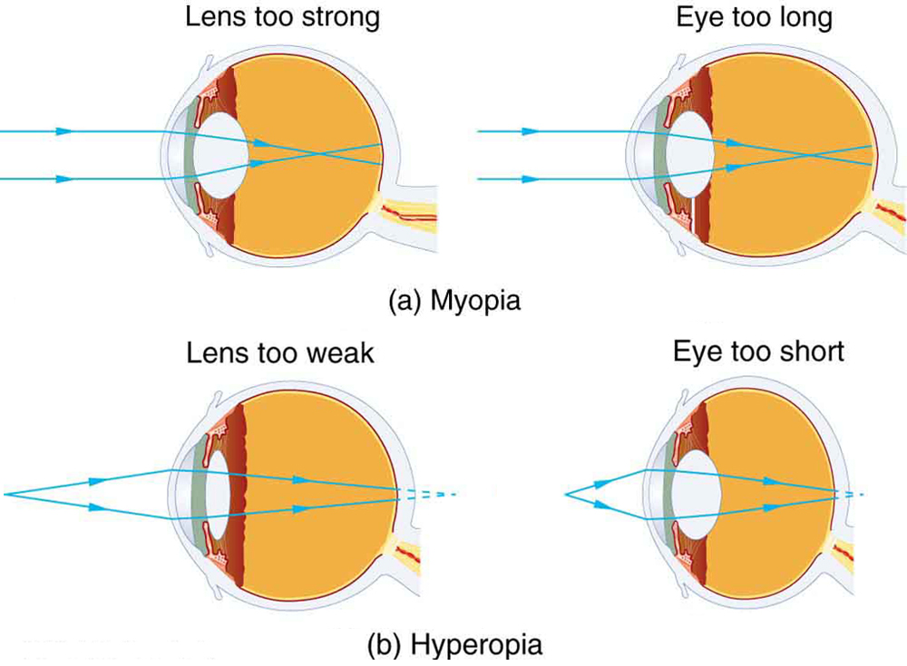 Vision Correction Physics