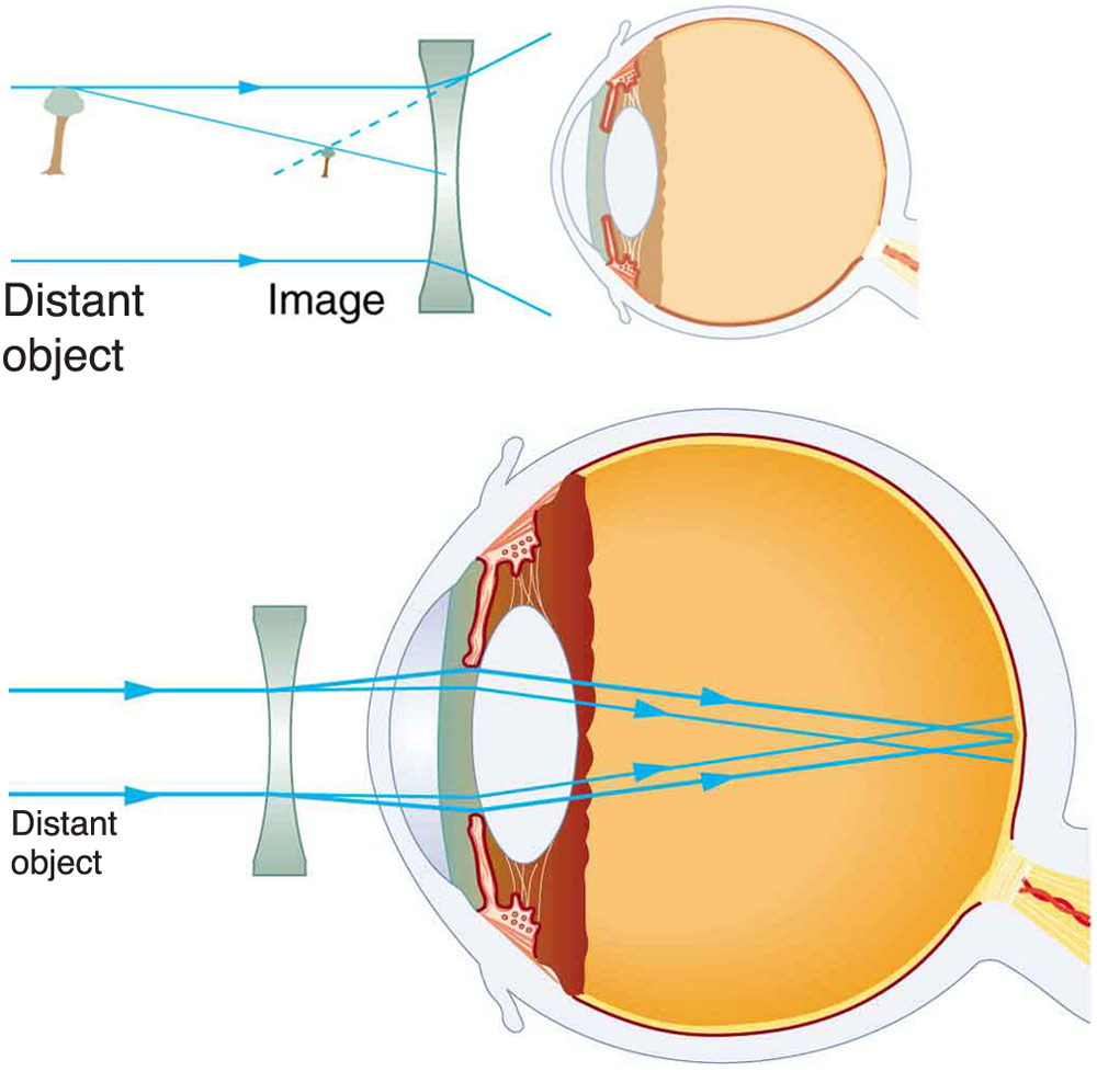 Vision Correction Physics